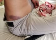 Terganggu Kondisi Fisik, Nereus Eno Korban Penganiayaan Oknum Polisi di SBD Belum Bisa Beri Keterangan